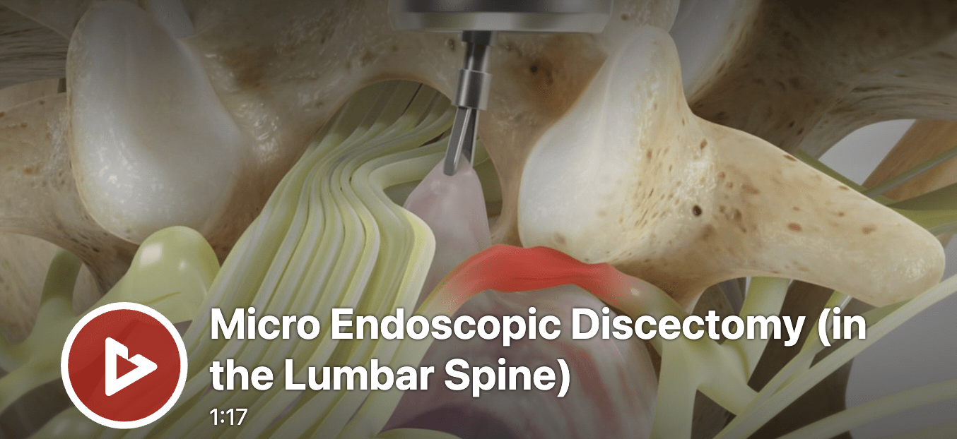 micro endoscopic discectomy in the lumbar spine