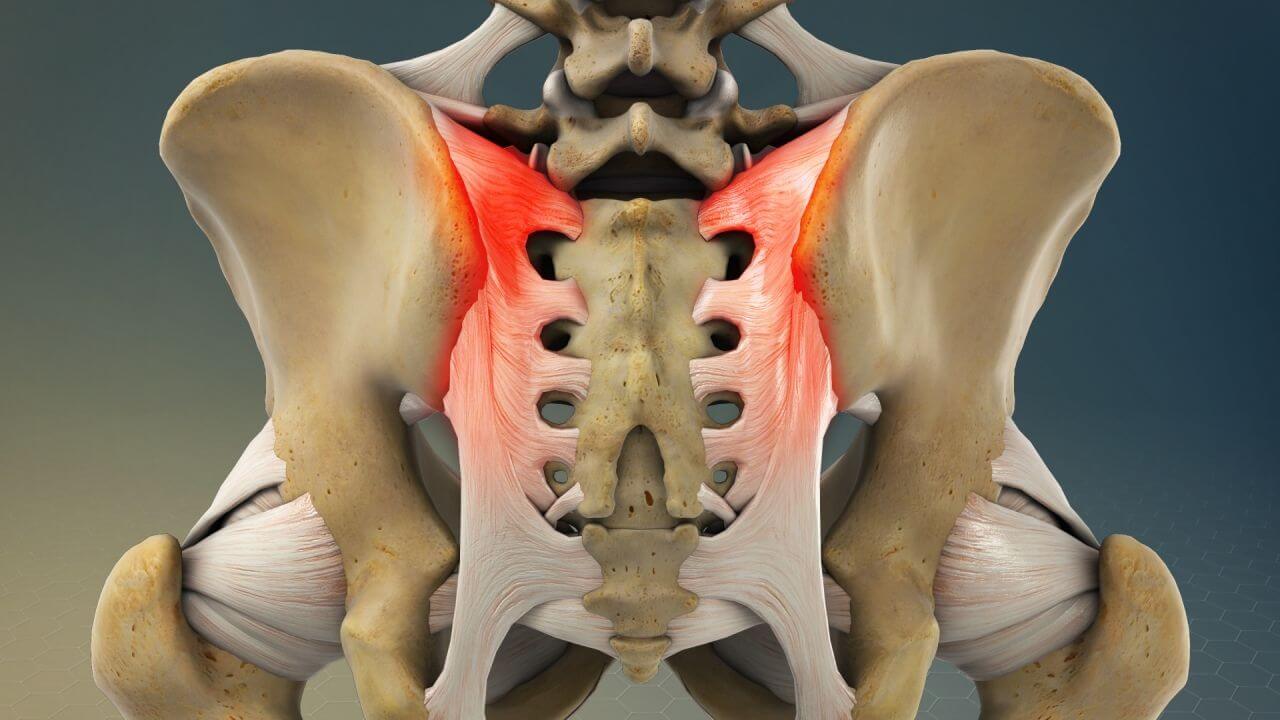 Model showing areas affected by sacroiliac joint dysfunction