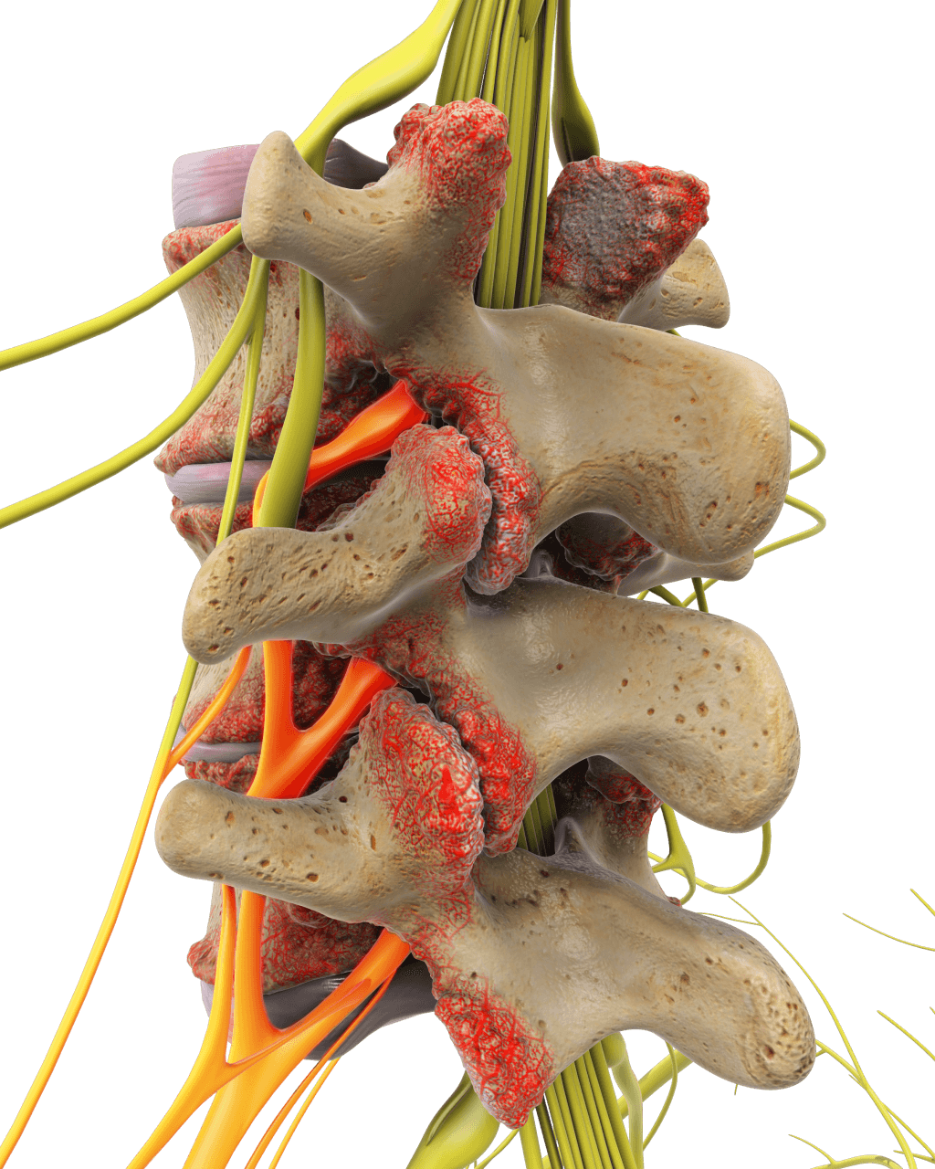 Spine model depicting facet joint syndrome