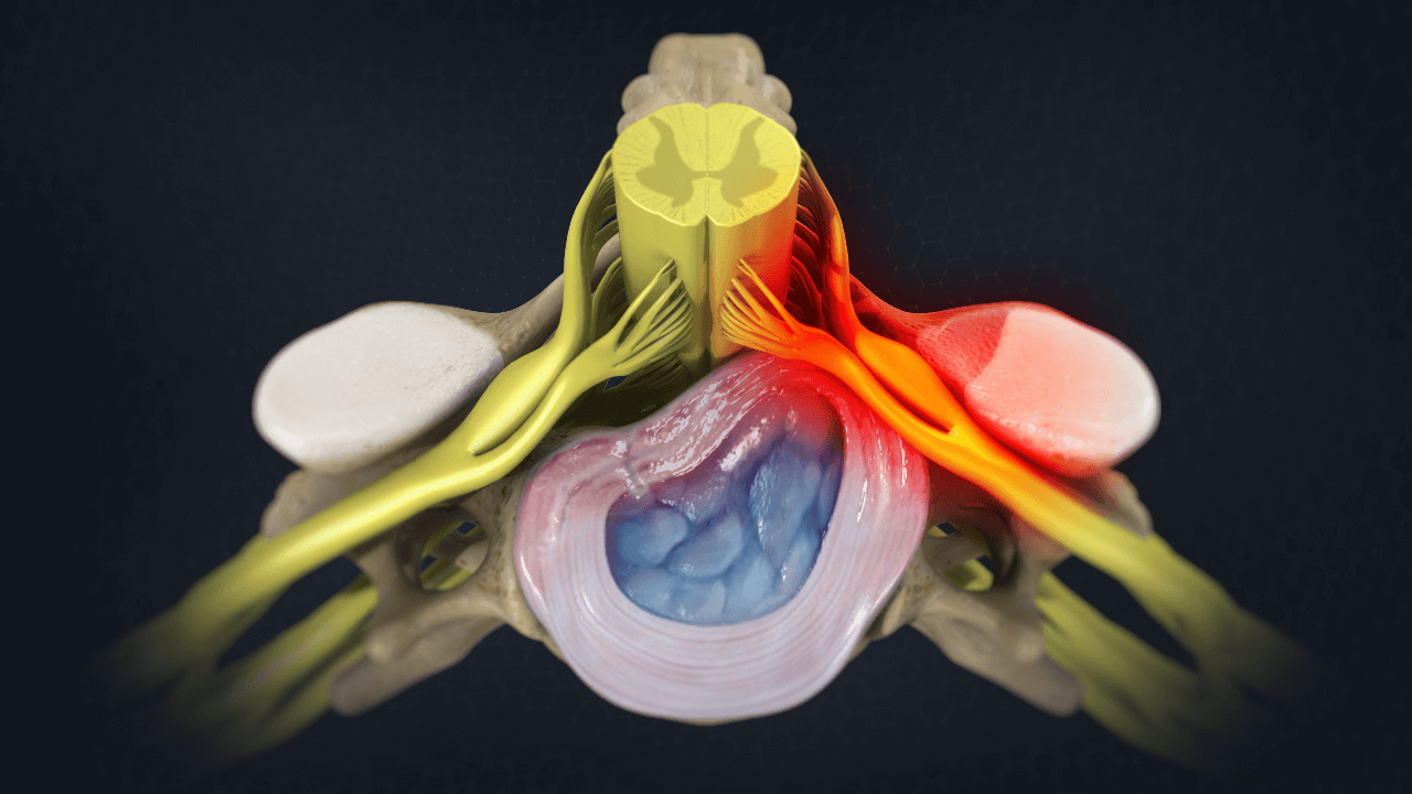 Model showing irritated nerves in the spine