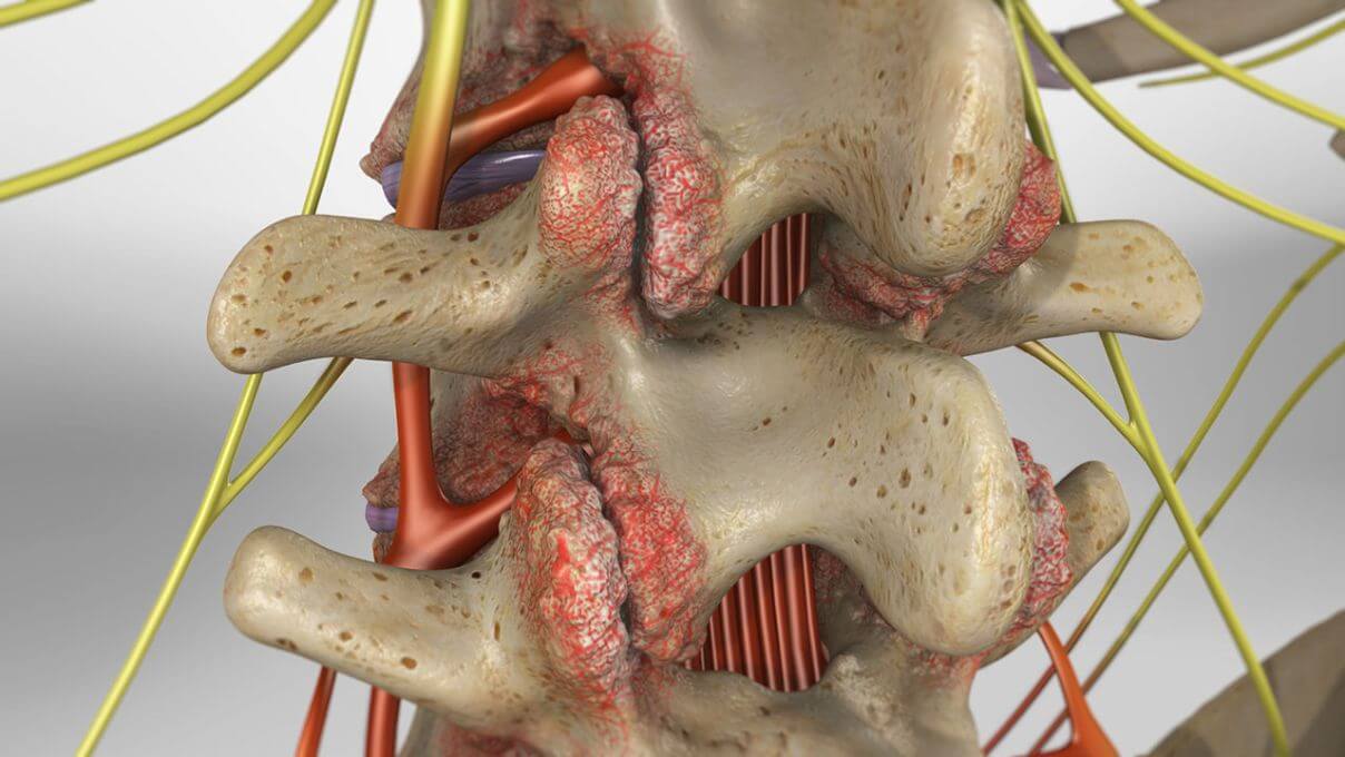 Model of the human spine with irritated joints