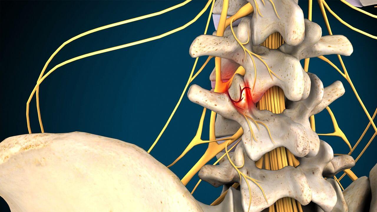 Facet joint in a human spine model, highlighted in red where there is pain from facet joint syndrome.