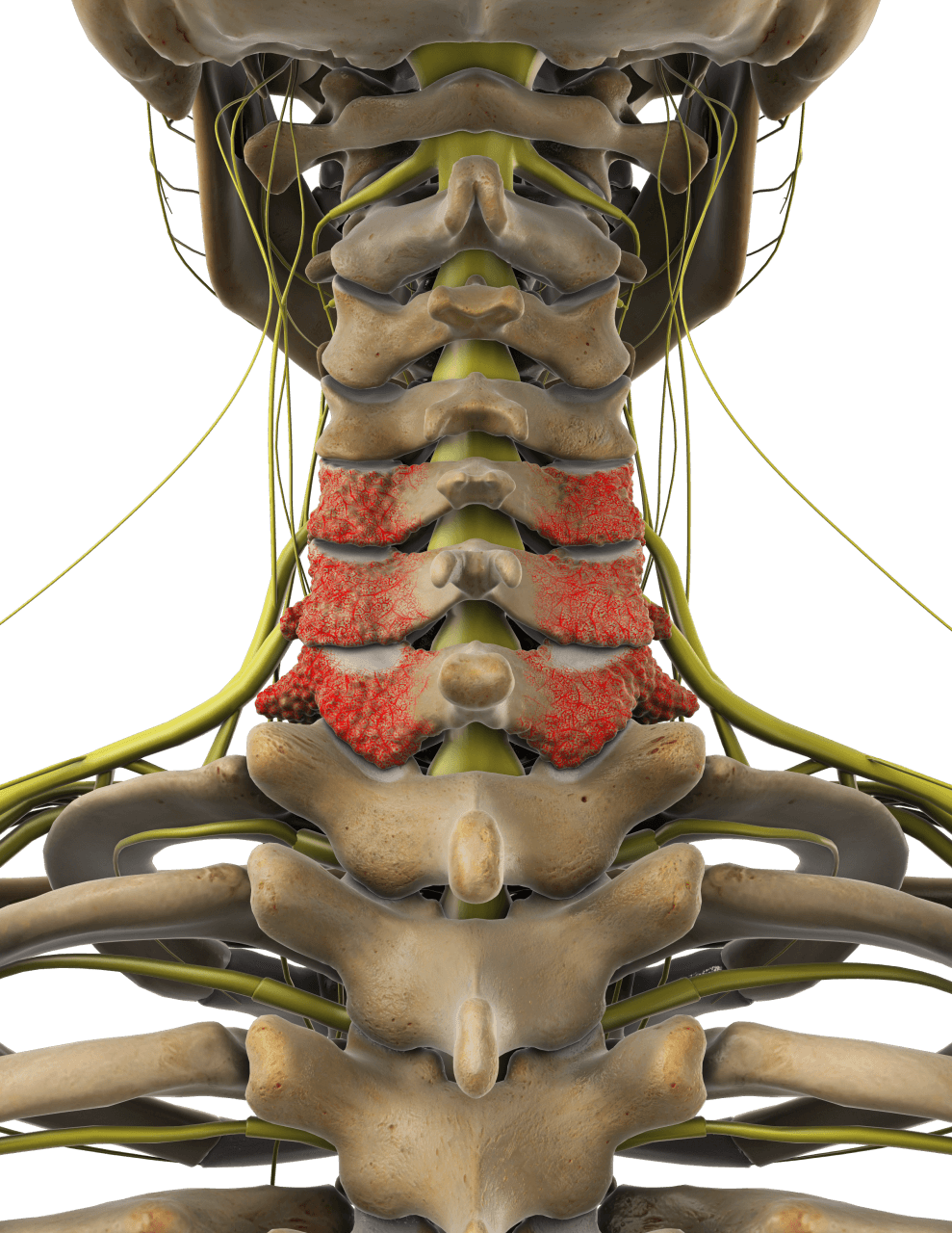 Model of human spine and neck showing foraminal stenosis