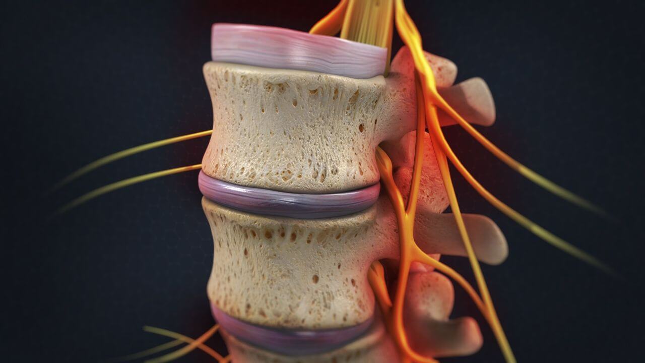 Model of the human spine with pinched nerves running through it