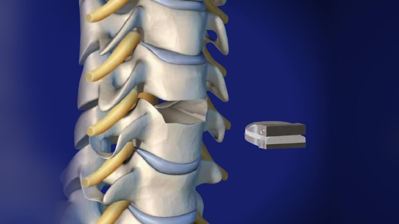 Artificial Cervical Disc Replacement (PCM)