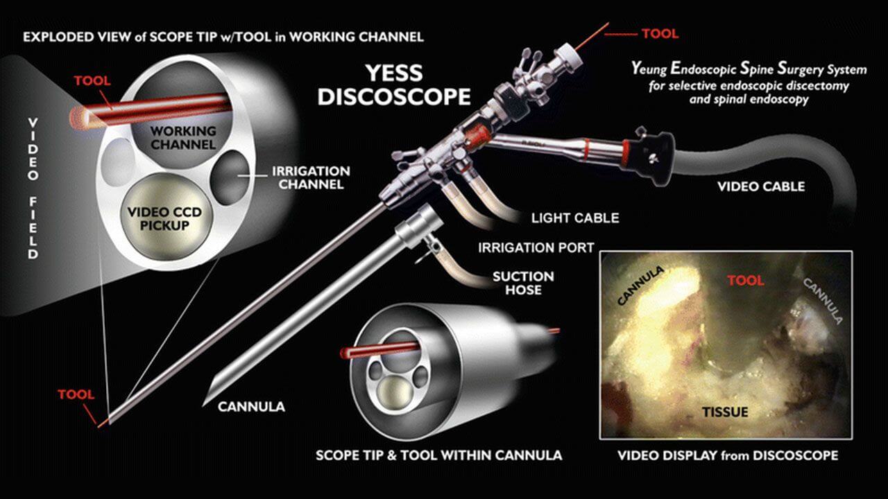 Diagram of the YESS discoscope