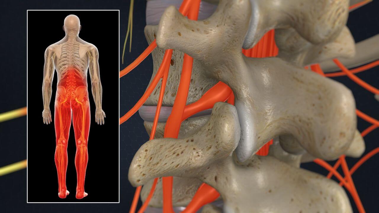 Model of human skeleton with areas affected by lower back pain highlighted