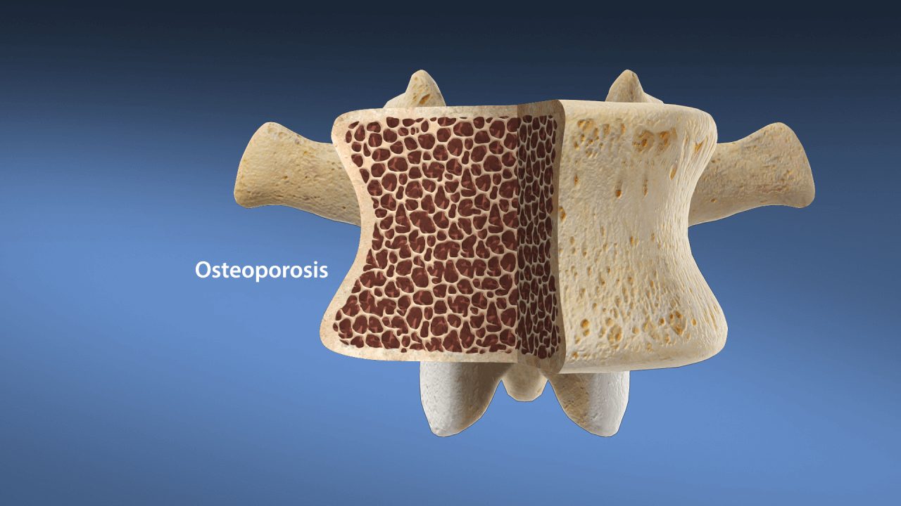 Depiction of a vertebrae that suffers from osteoporosis