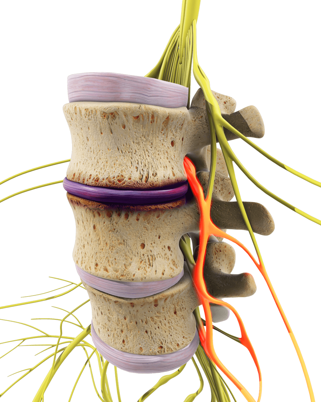 Model of spine vertebrae with a pinched nerve running through it