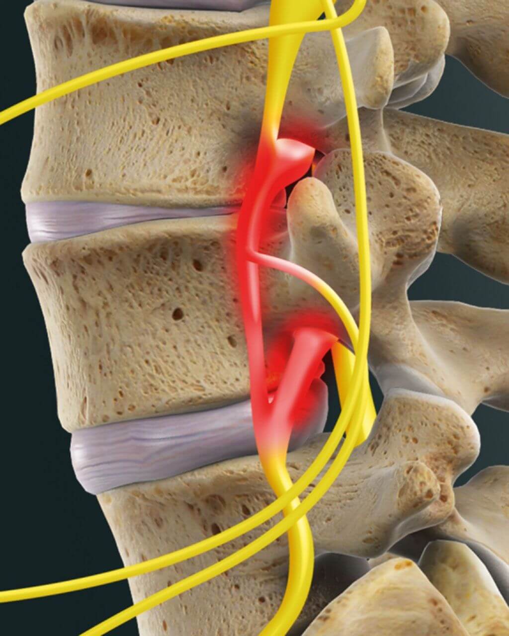 Model of nerves along the spine with radiculitis