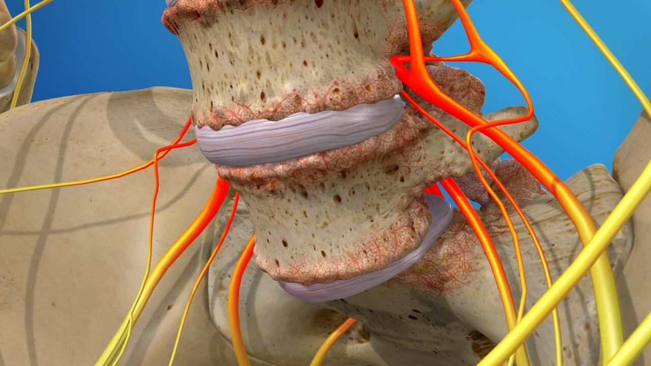 Model of the human spine demonstrating spondylolisthesis