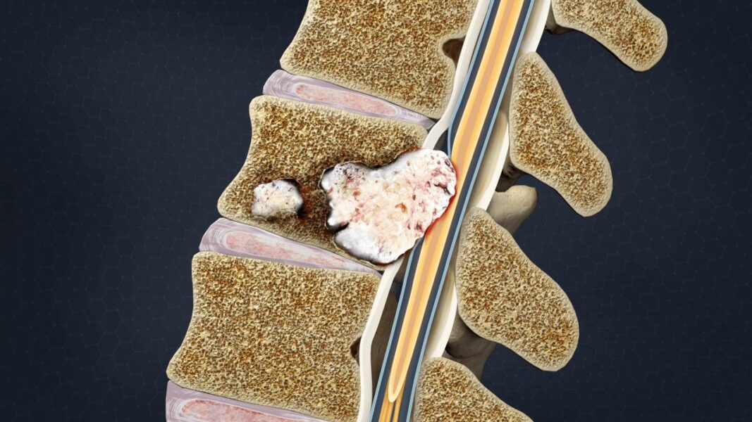 Spinal Tumor Common Causes, Symptoms, and Treatment Options