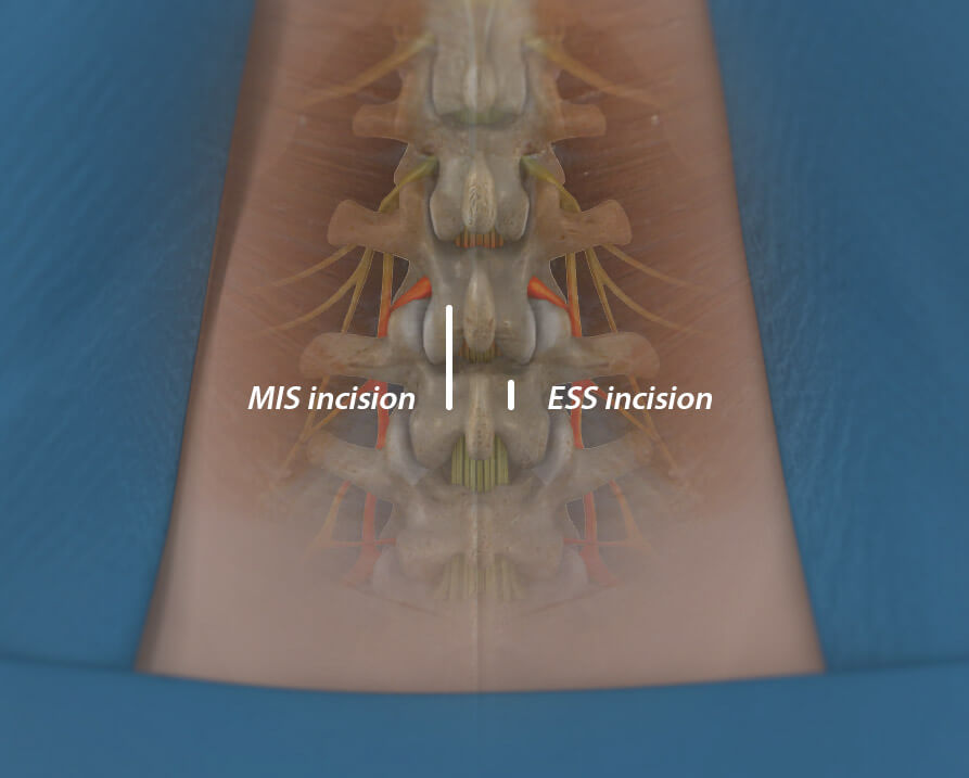 An MIS incision versus an ESS incision