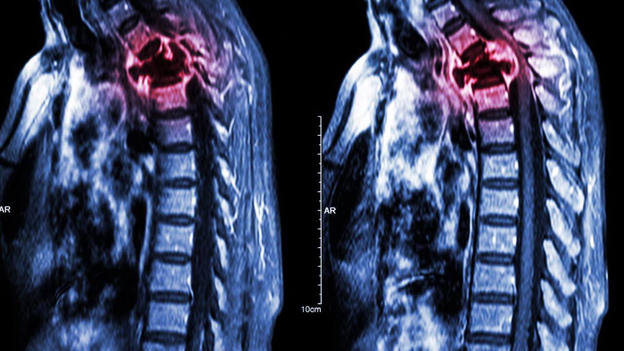Medical imaging showing a spinal tumor