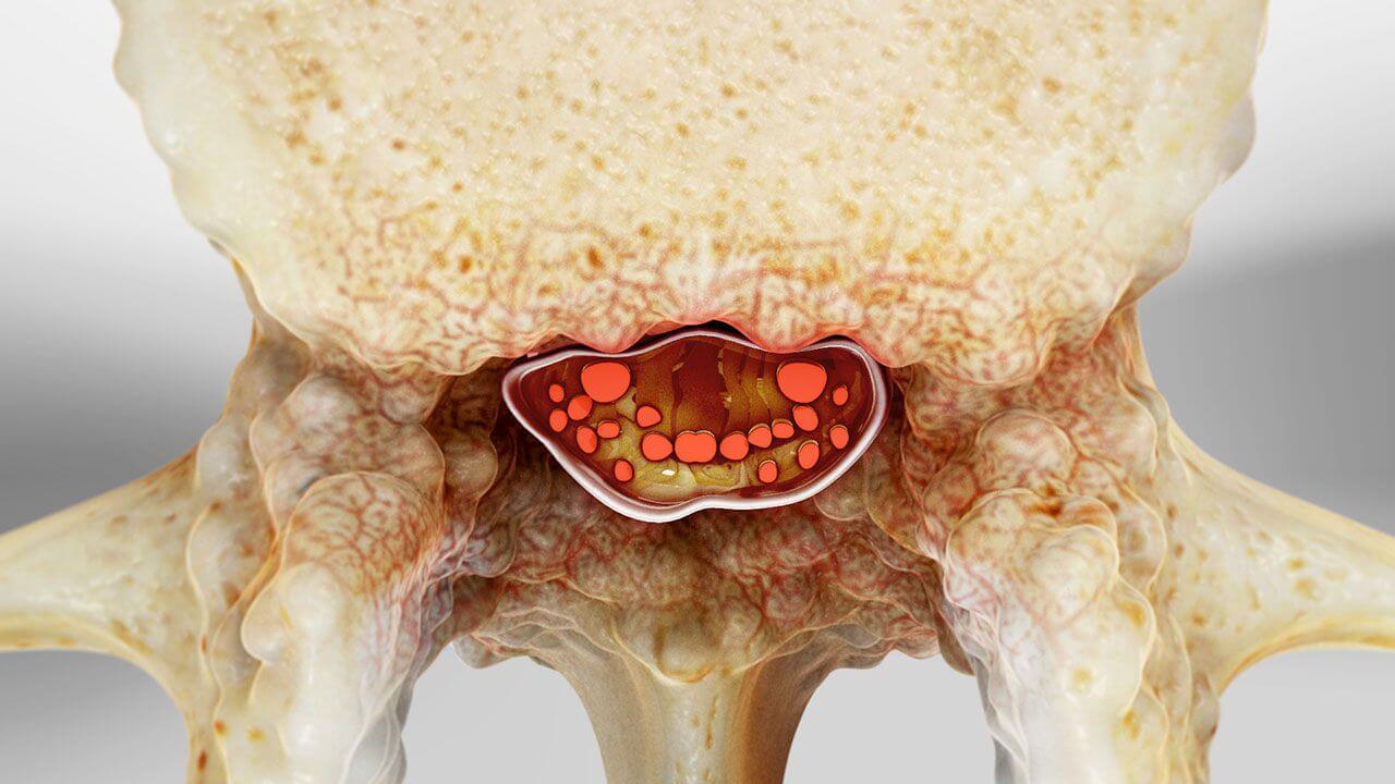 Model depicting spinal stenosis