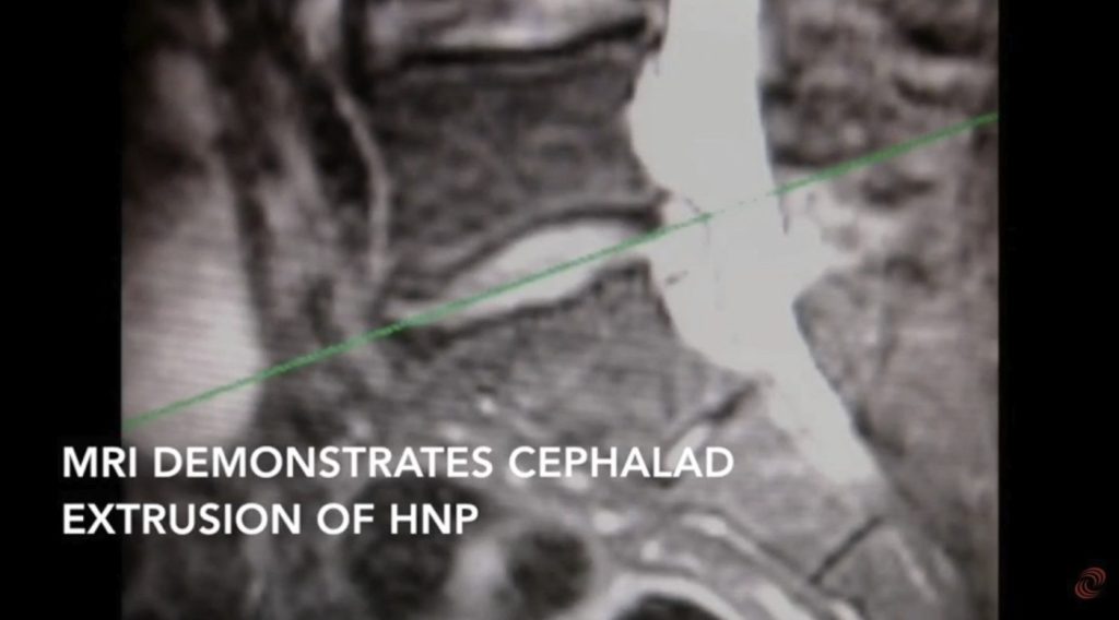 Endoscopic Foraminoplasty Surgery and Procedure in AZ DISC