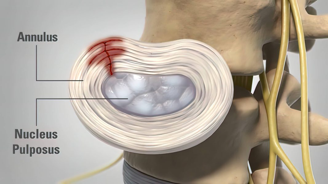 Annular Disc Tear Diagnosis and Treatment in Arizona DISC