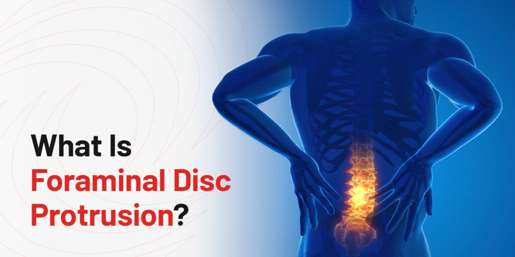 What Is Foraminal Disc Protrusion?
