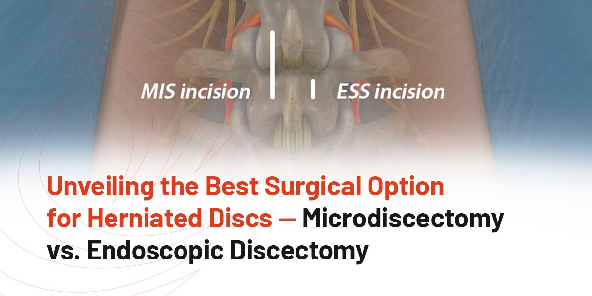 Unveiling the Best Surgical Option for Herniated Discs — Microdiscectomy vs. Endoscopic Discectomy