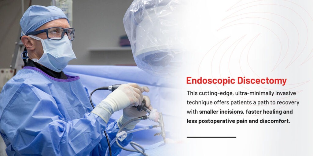 Endoscopic Discectomy — The Ultra-Minimally Invasive Challenger