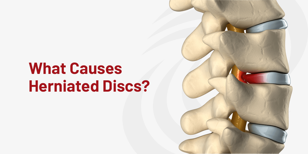 What Causes Herniated Discs?