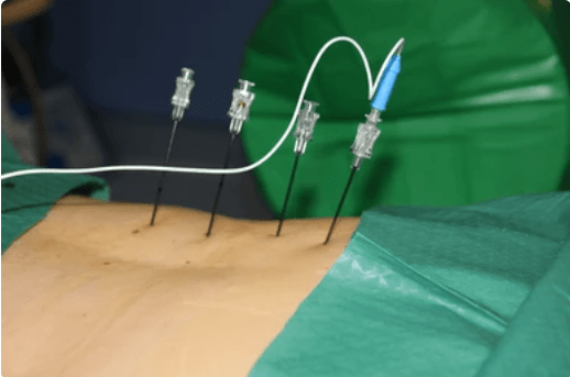 Percutaneous Radiofrequency Ablation