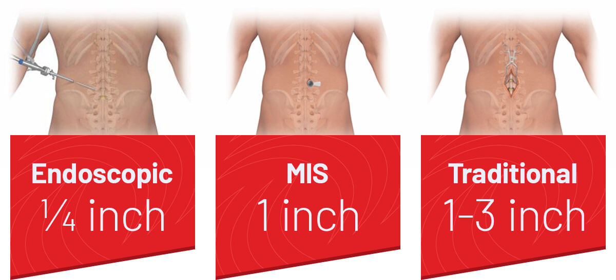 Types of spine surgery