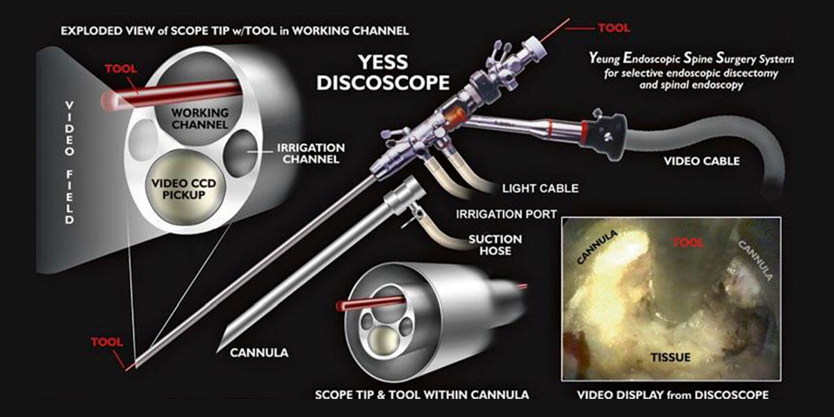 Original Yeung endoscopic spine surgery system