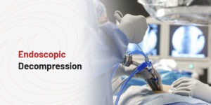 What Is Endoscopic Decompression?