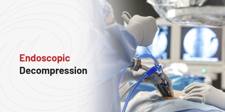 What Is Endoscopic Decompression?